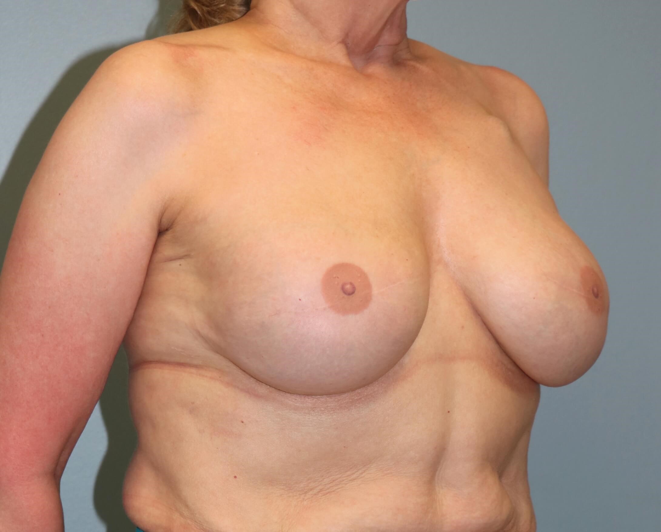 Prepectoral Implant Recon After Implant Reconstruction