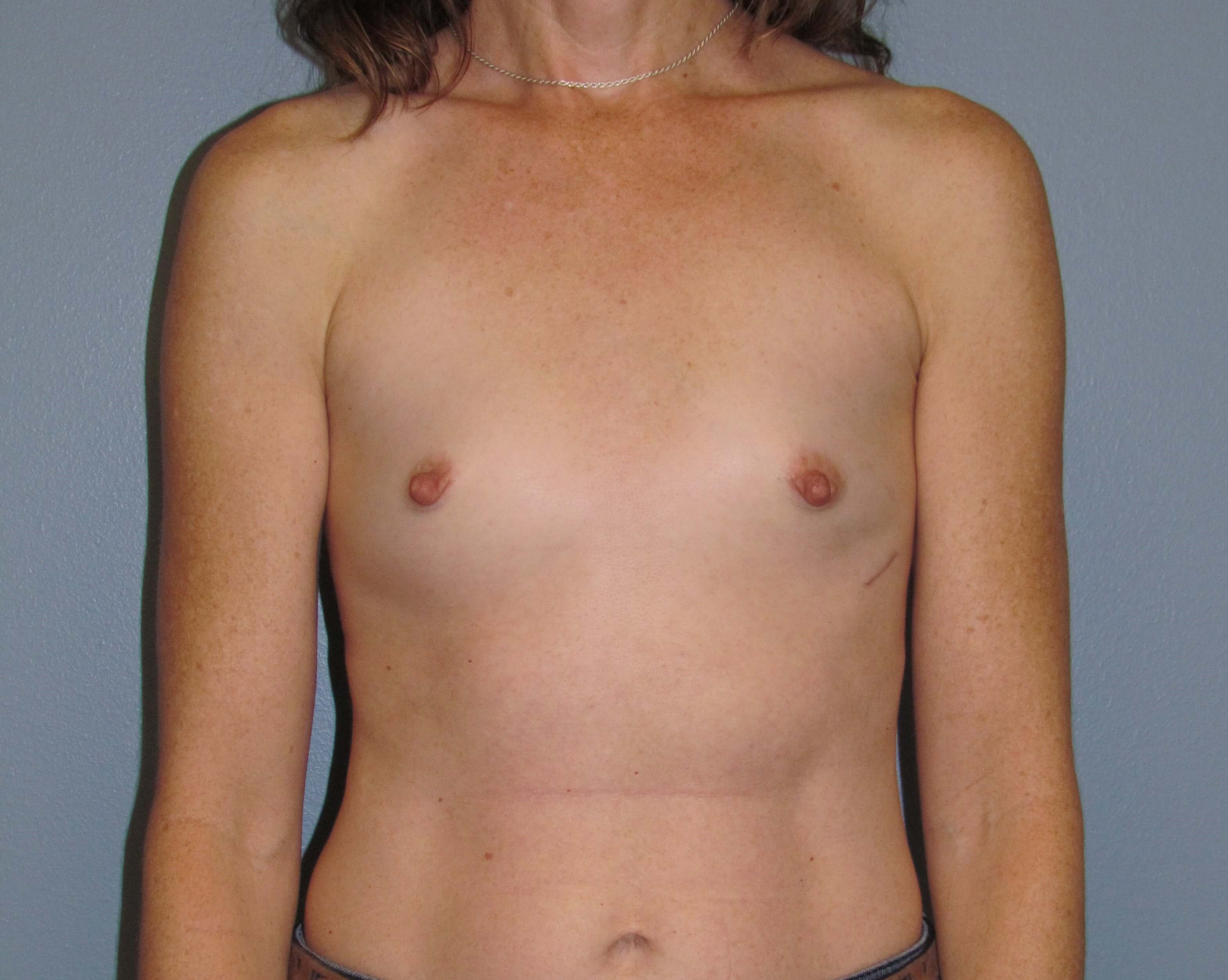 Breast Aug Before & After Before Breast Augmentation