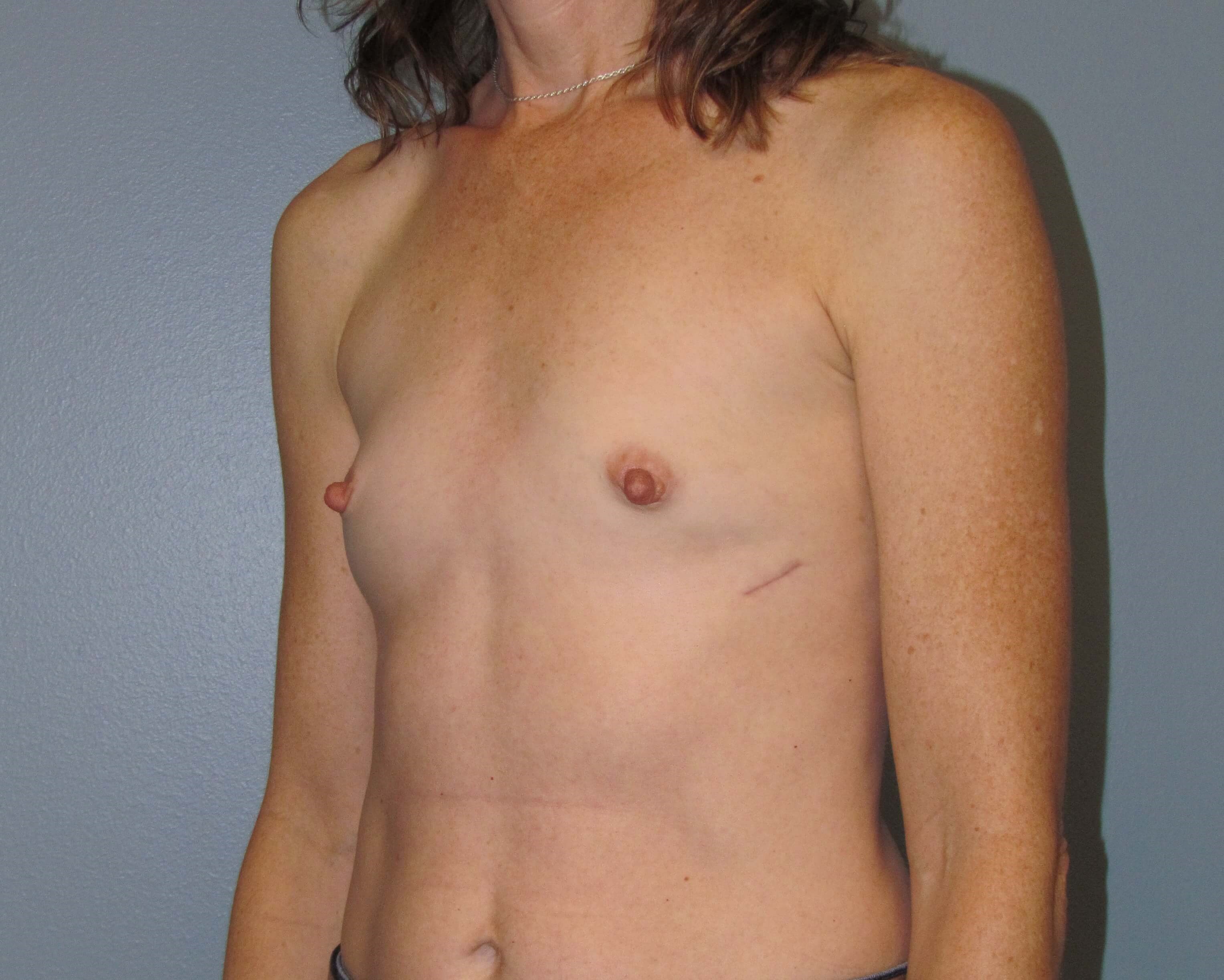 Breast Aug Before & After Before Breast Augmentation