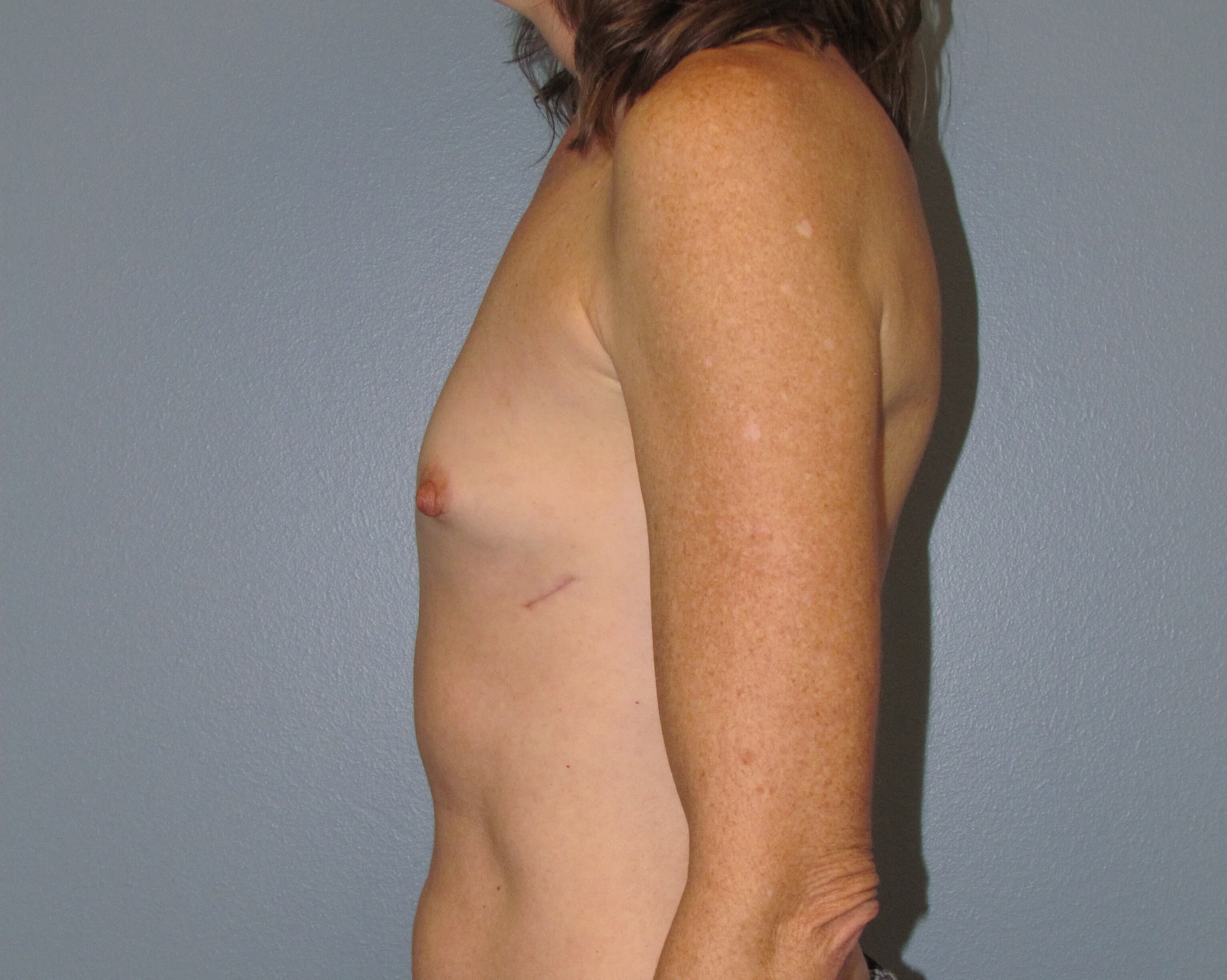 Breast Aug Before & After Before Breast Augmentation