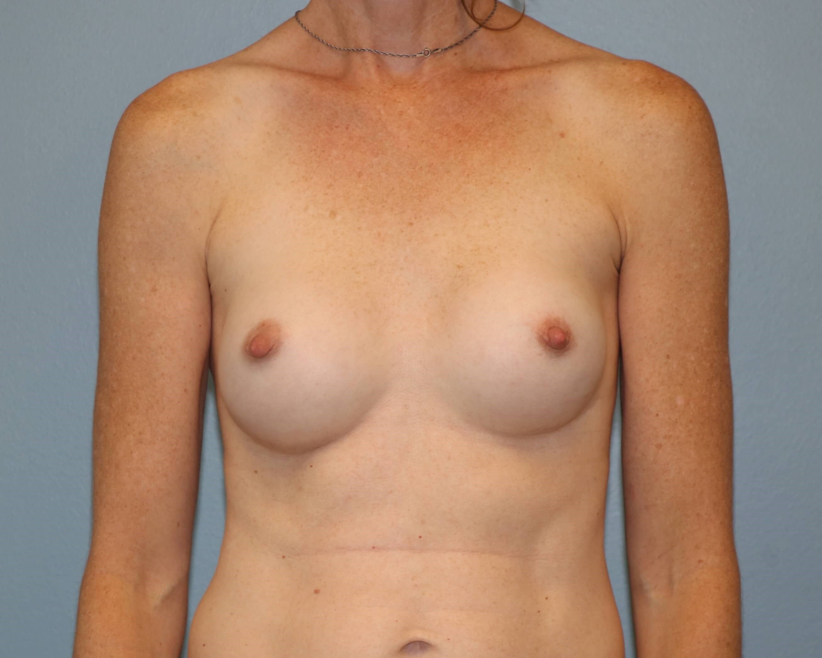 Breast Aug Before & After After Breast Augmentation