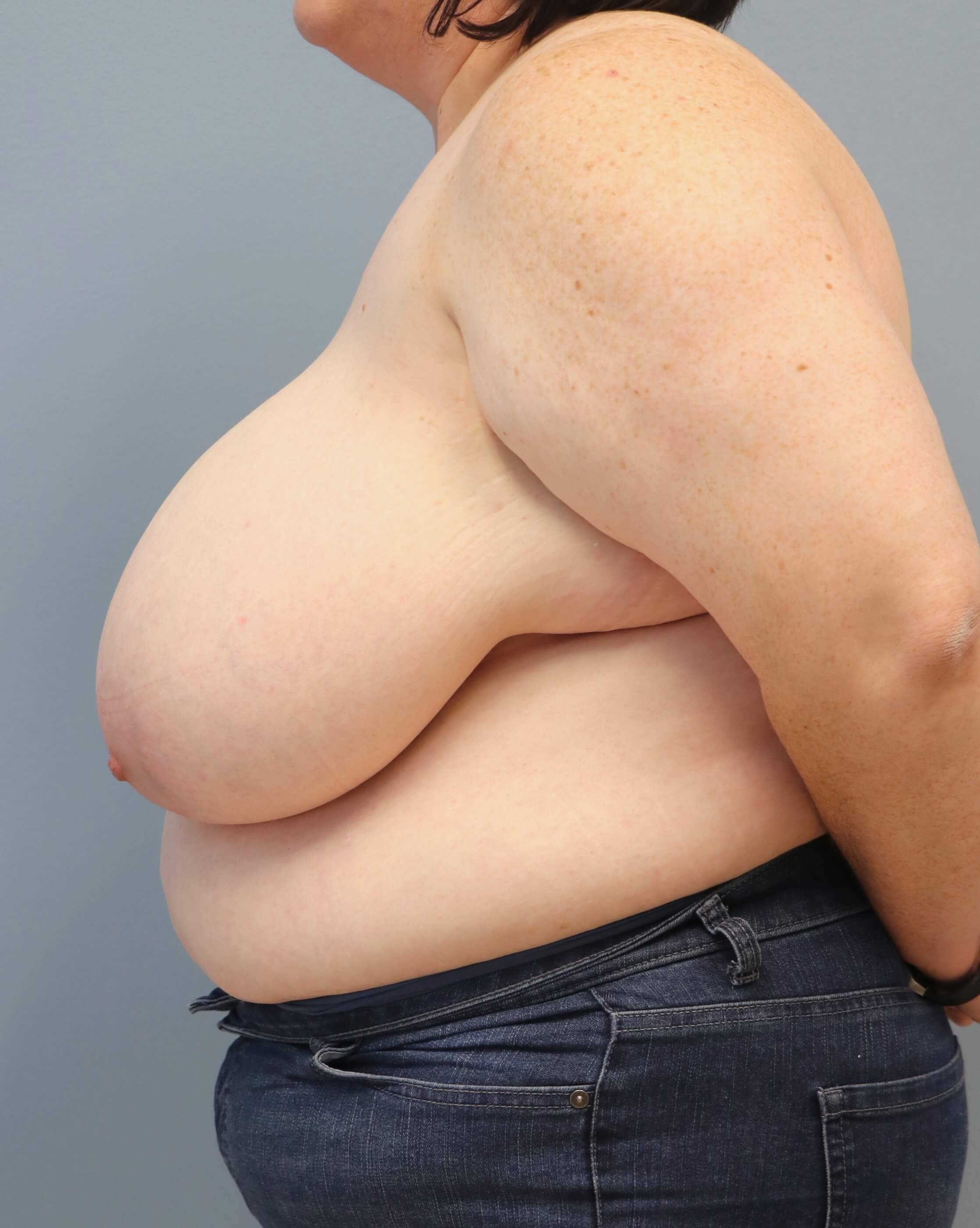 Breast Reduction & Liposuction Before Breast Reduction