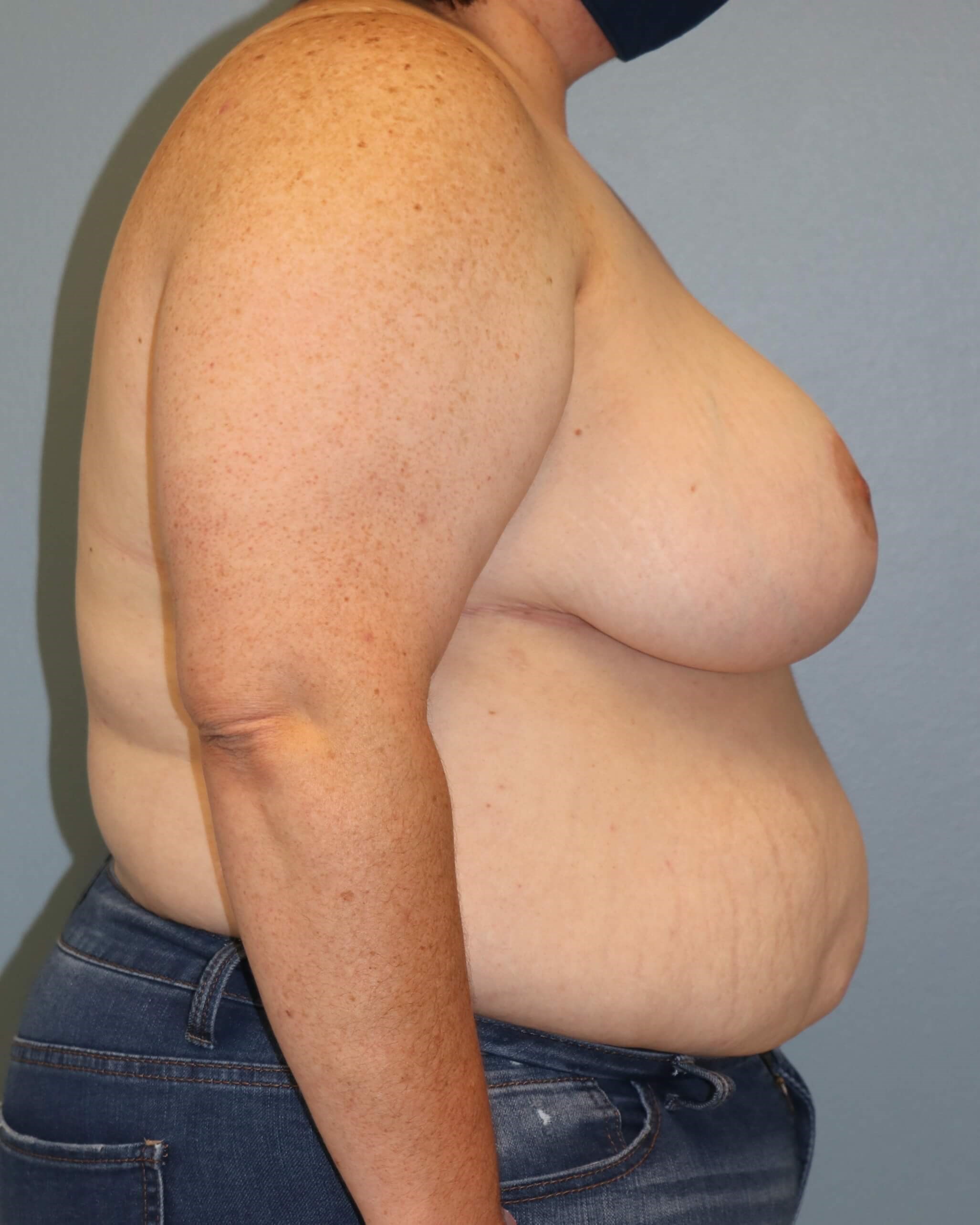 Breast Reduction & Liposuction After Breast Reduction