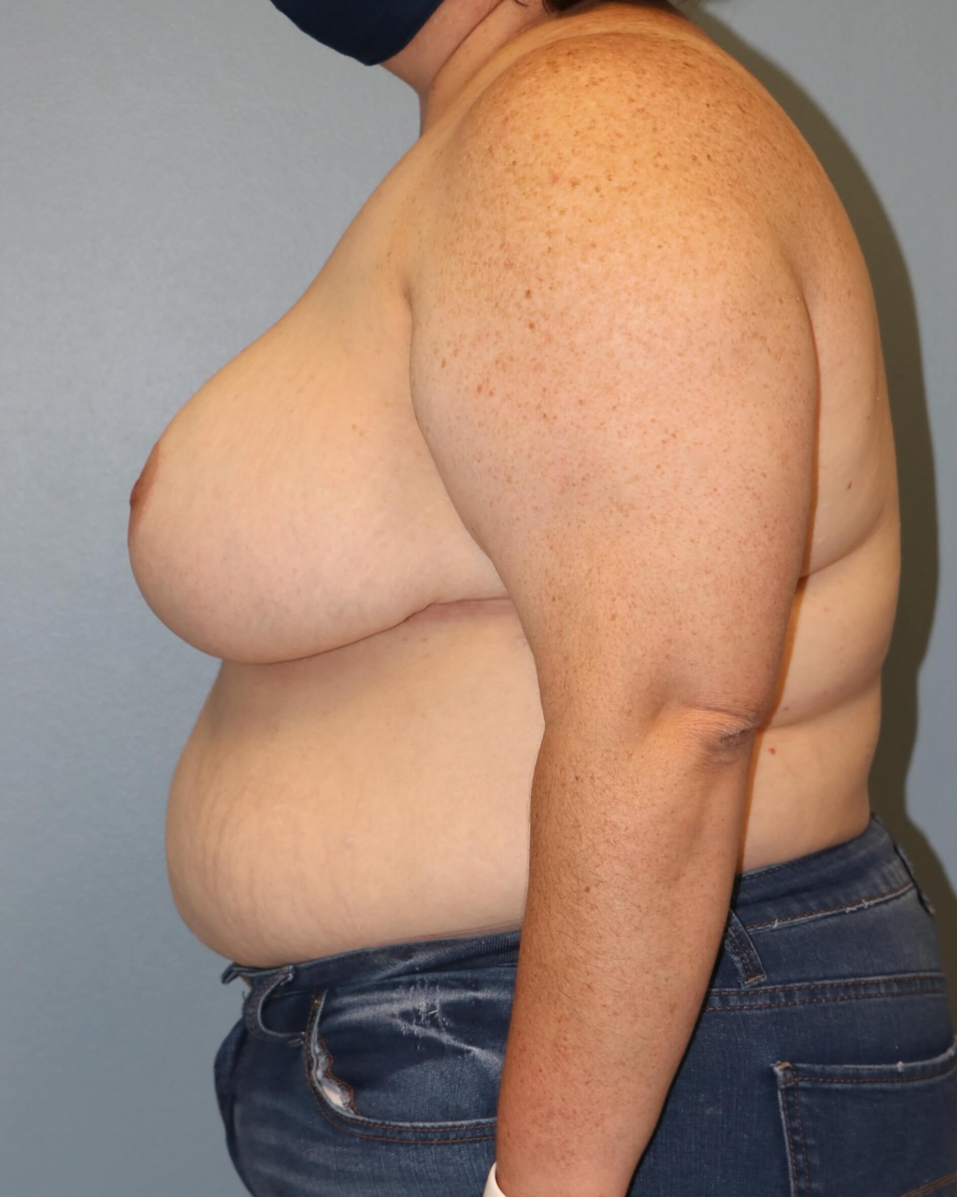 Breast Reduction & Liposuction After Breast Reduction