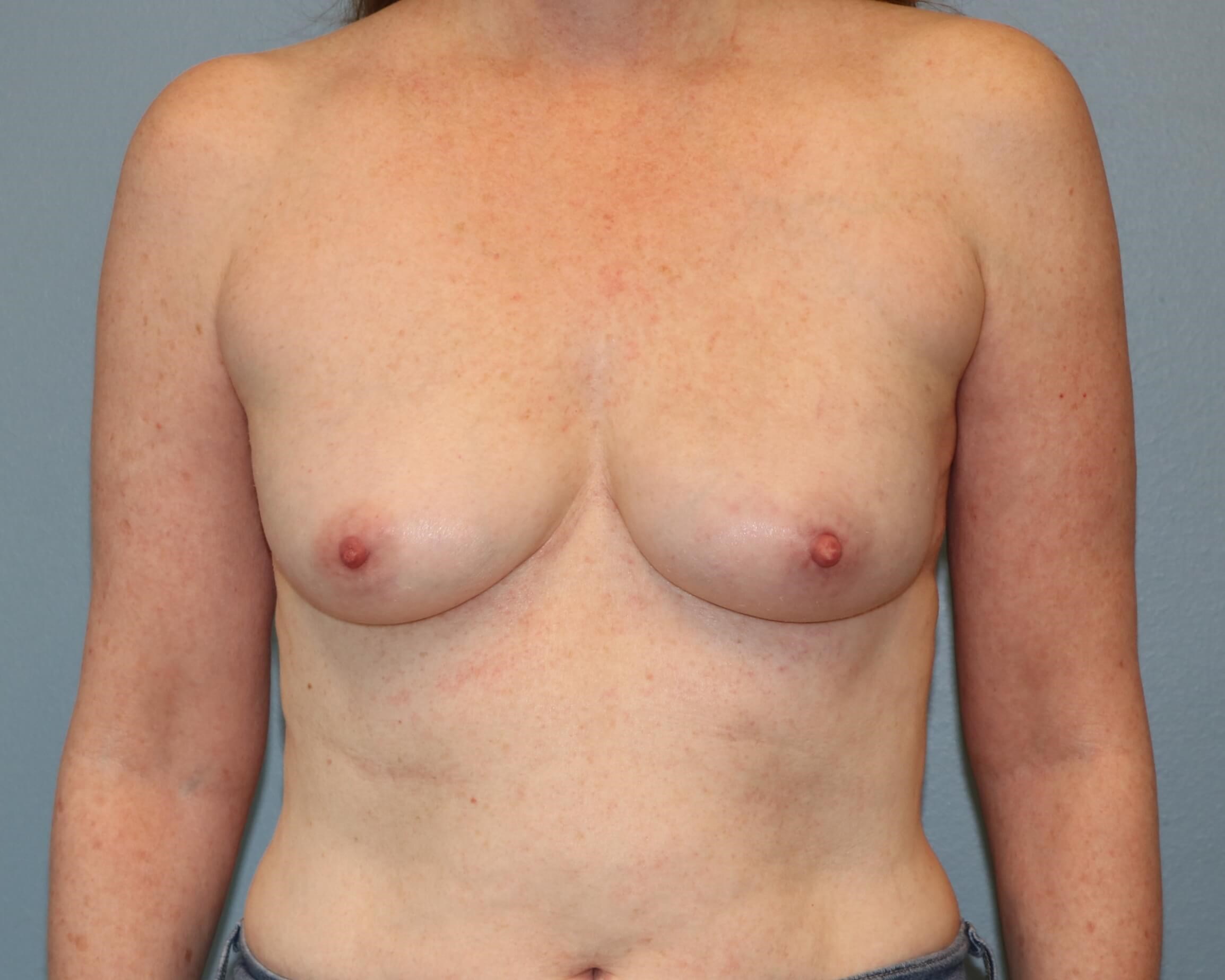 Left Implant Reconstruction After Implant Reconstruction