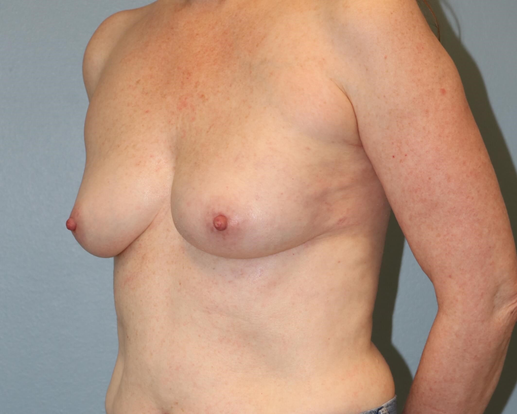 Left Implant Reconstruction After Implant Reconstruction
