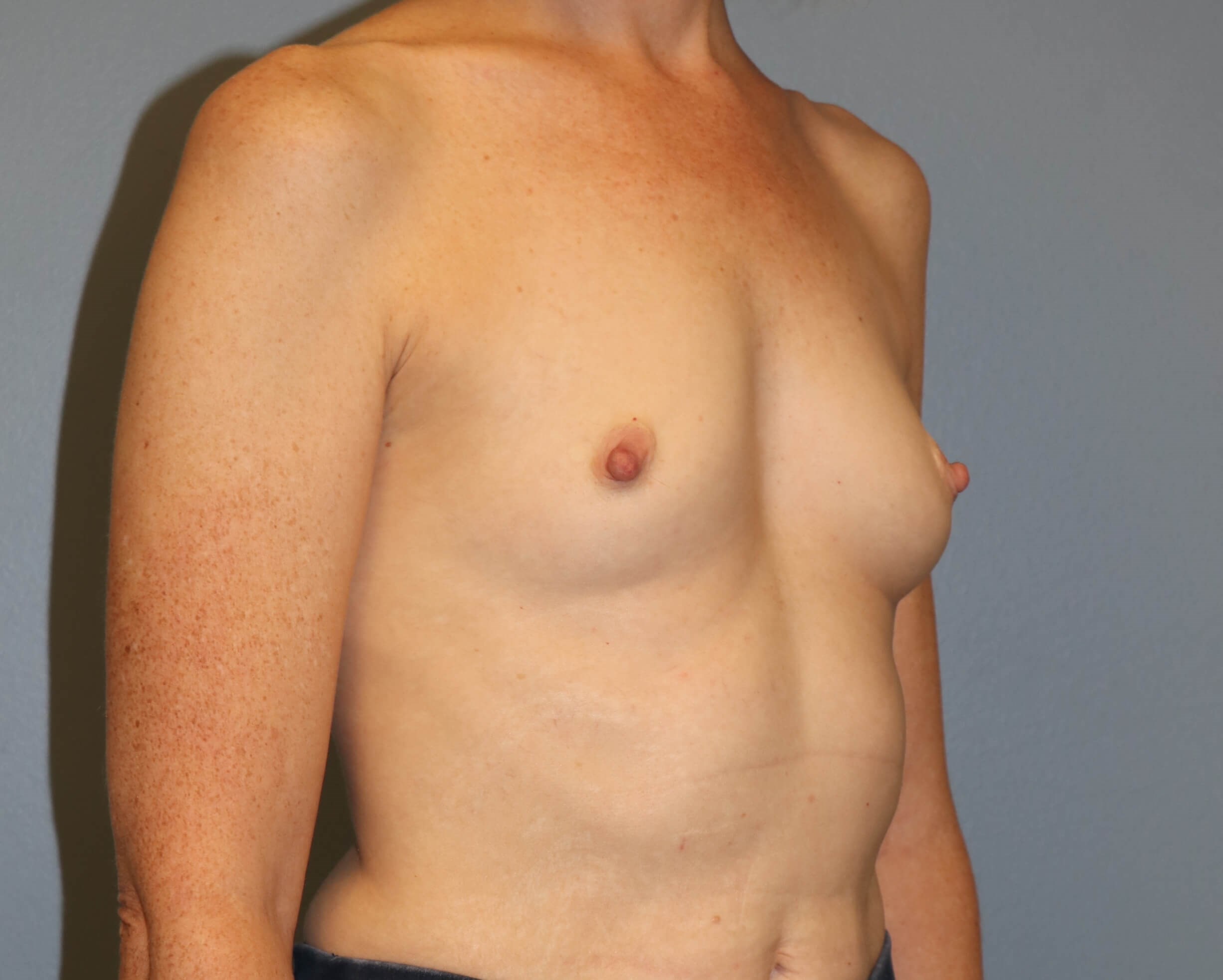 Prepectoral Implant Recon Before Prepec Reconstruction