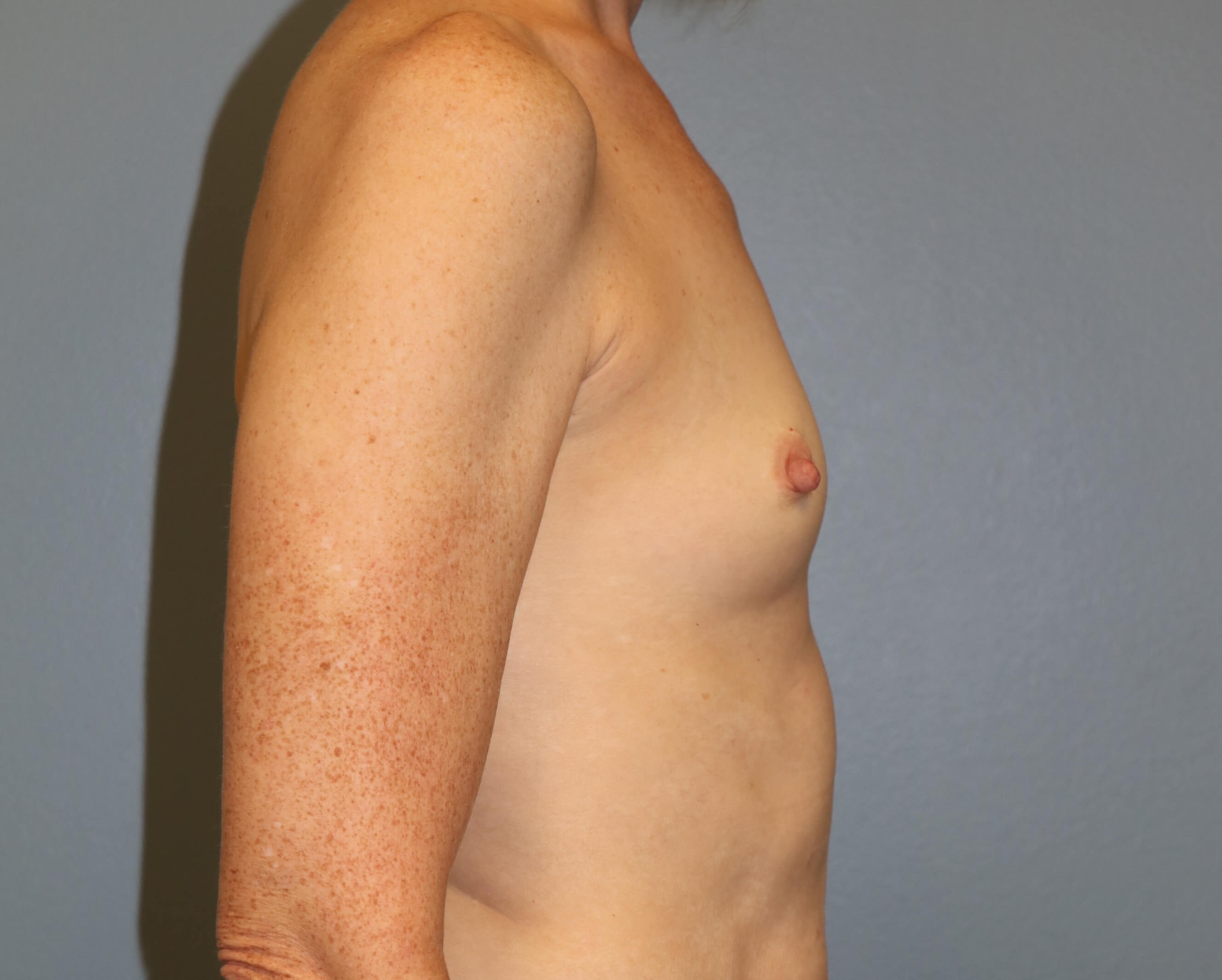 Prepectoral Implant Recon Before Prepec Reconstruction