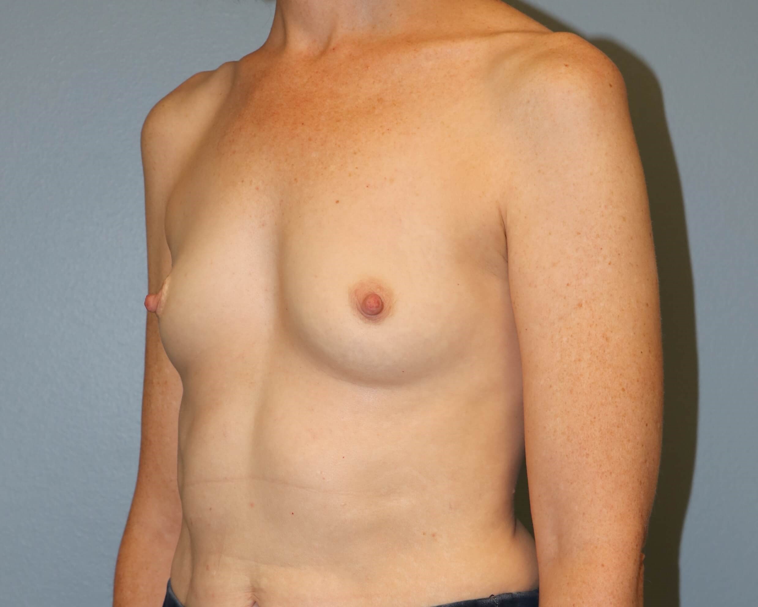 Prepectoral Implant Recon Before Prepec Reconstruction