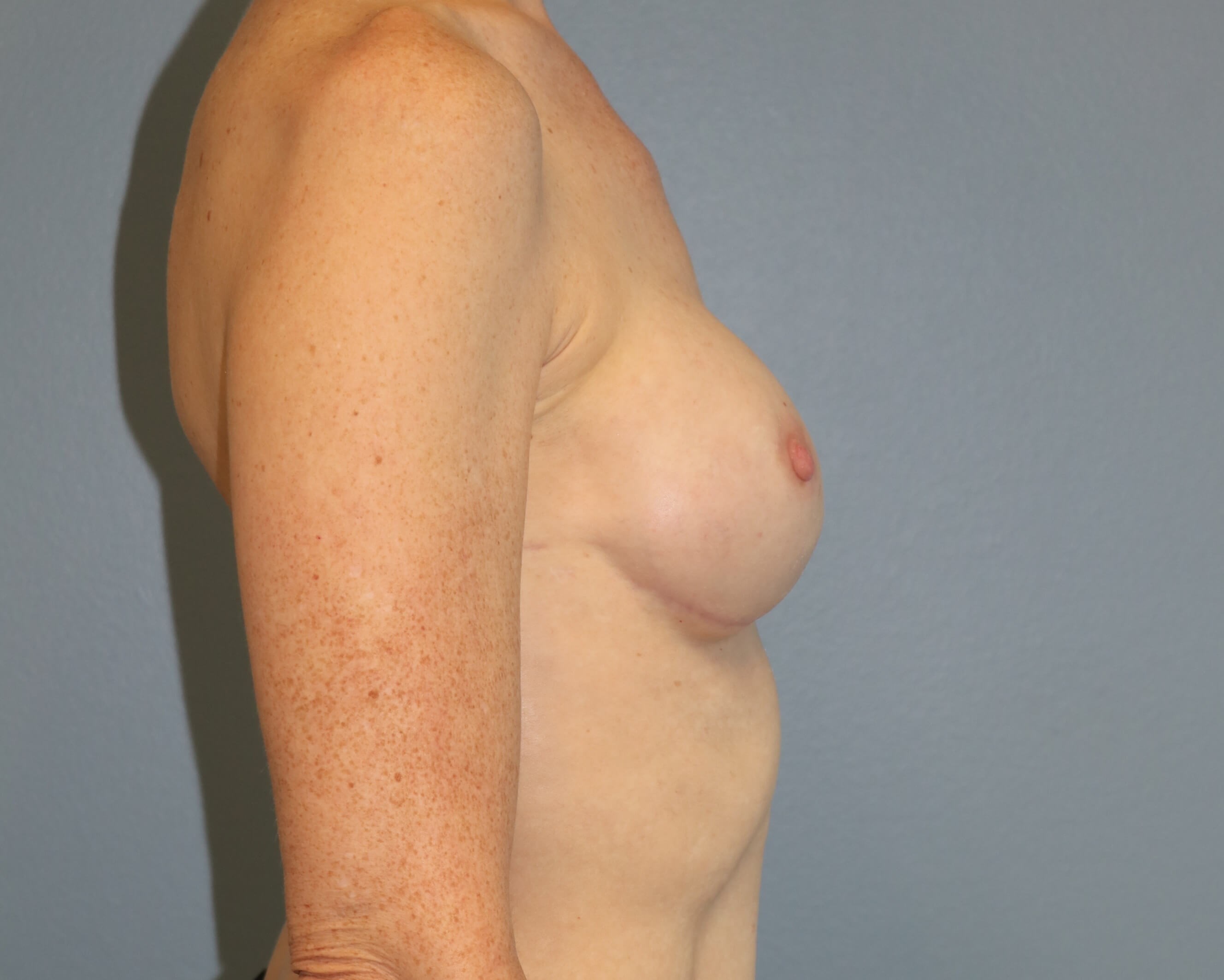 Prepectoral Implant Recon After Prepec Reconstruction